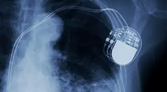 X-ray showing implanted pacemaker