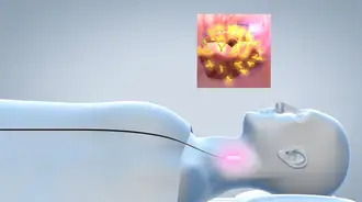 Diagram of a luminous diffuser treating a tumor inside the throat