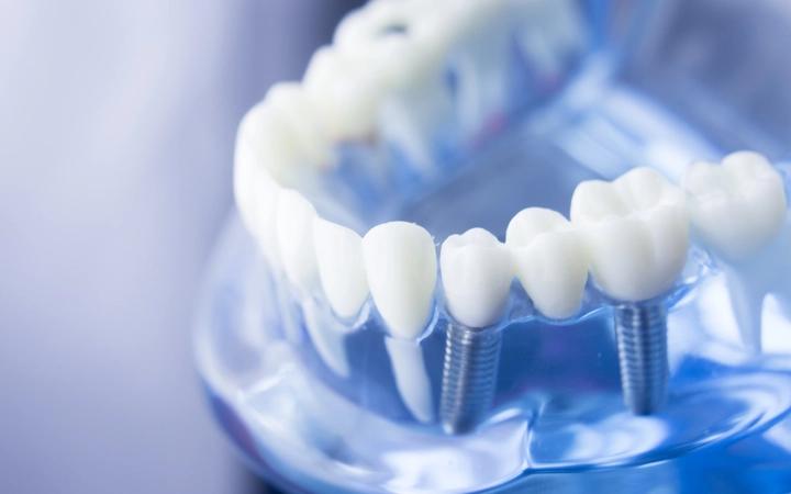 Two dental implants in a model of a mouth