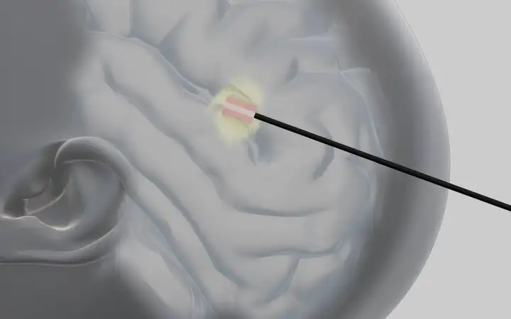 illustration of a brain with a cylindrical laser fiber probe radiating yellow light