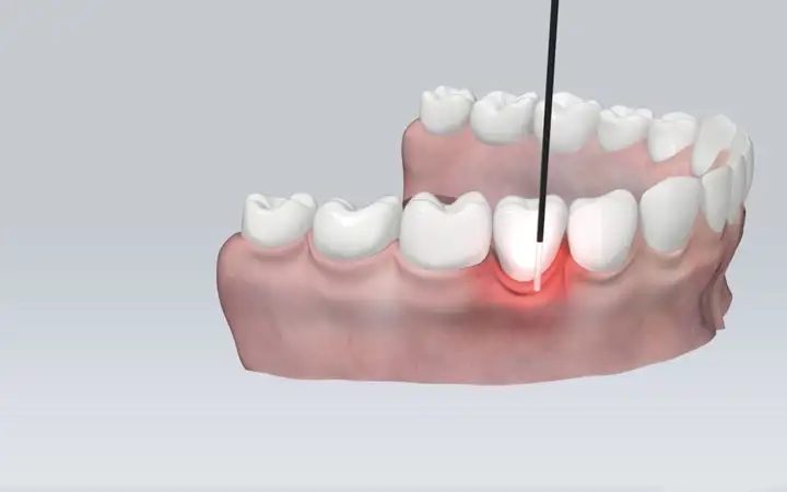 illustration of teeth and gums, a laser diffusor radiating red light is healing inflammed gum tissue